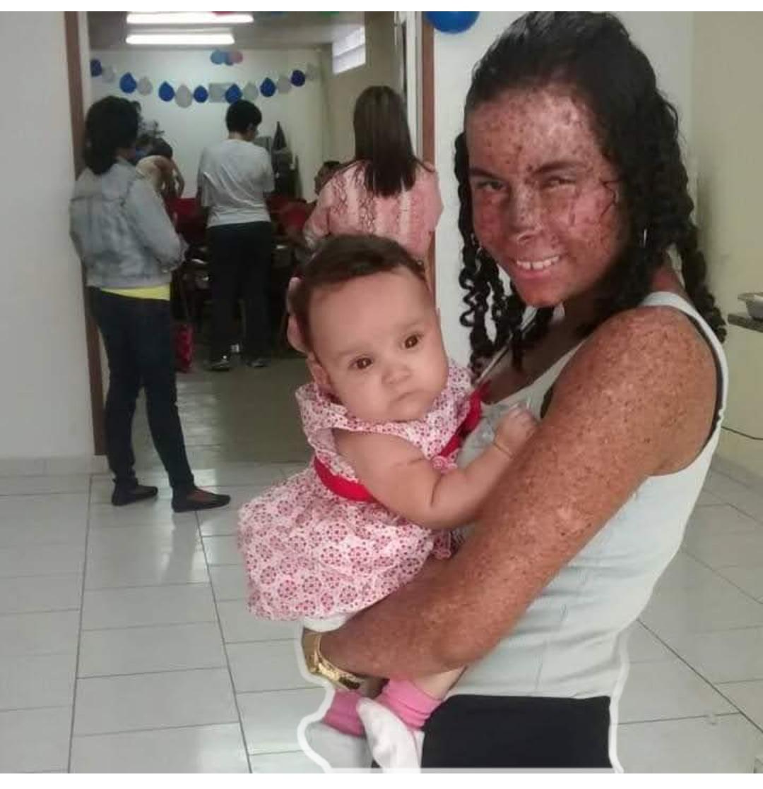 Jéssica Cerqueira, 27, who has xeroderma pigmentosum, has always faced the consequences of the lack of urban infrastructure to protect her from the heat and the sun in the favela. Photo: Personal Archive Jéssica Cerqueira, 27, who has xeroderma pigmentosum, has always faced the consequences of the lack of urban infrastructure to protect her from the heat and the sun in the favela. Photo: Personal Archive
